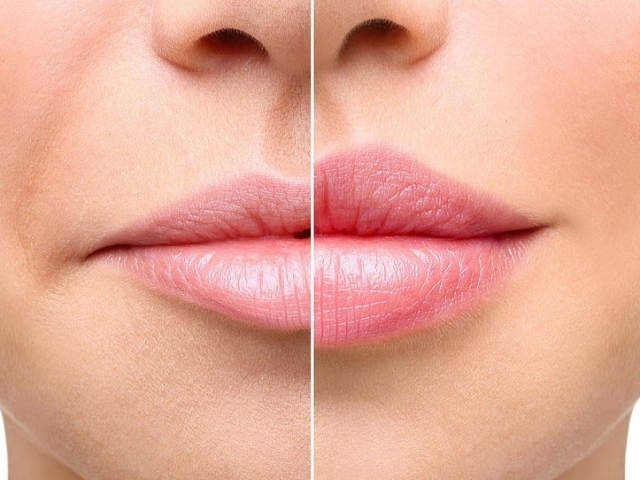 Comment augmenter les coins abaissés des lèvres: maison et cosmétologie, exercices, massage, maquillage, charges, conseils, critiques