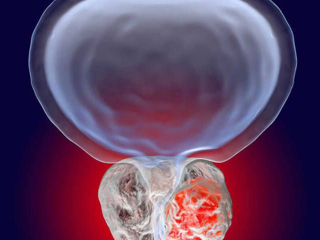 La biopsie de la prostate chez les hommes après 50 ans: comment les diagnostics se déroulent-ils, à quoi sert le danger? Les méthodes folkloriques les plus efficaces pour traiter le cancer de la prostate