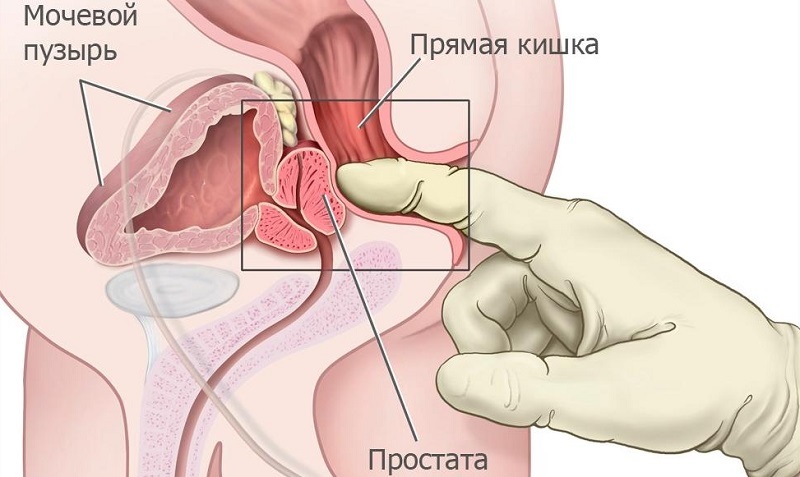 Masaža prostate