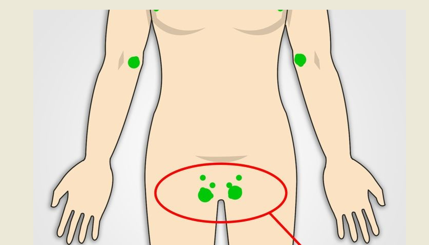 Nodul limfatic în inghinala unei femei, bărbați: motive, ce să facă? Cum se tratează limfadenita: medicamente, metode populare