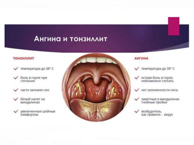 Tonsilitis, sakit tenggorokan - hal yang sama atau tidak: bagaimana membedakan ketika antibiotik diresepkan?