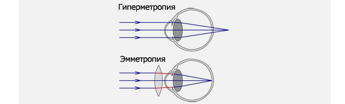 Что значит гиперметропия. Эмметропия миопия гиперметропия. Гиперметропия клинические рекомендации. Классификация гиперметропии. Гиперметропия что это у ребенка 3 года.