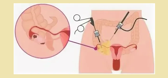 Laparoskopija, če ni ovulacije