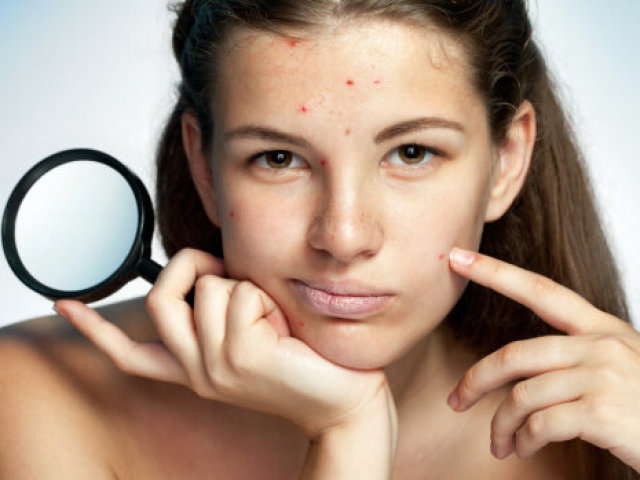 Acne on the chin in girls, women and men: signs. What a pimple jumped up on a girl’s chin, a woman, a guy: a sign