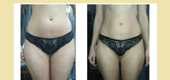 Ручной массаж живота для похудения фото до и после