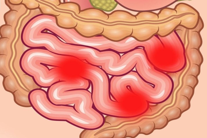 Enteritis crónica