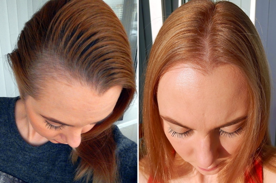Darsonval for hair: before and after
