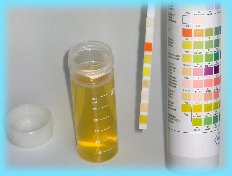 Determination of urine color is an important indicator of laboratory diagnostics