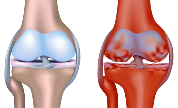 Osteoarthrosis of the knee joint