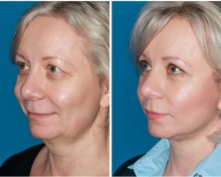 Ритидэктомия кожи лица и шеи: что это такое, преимущества и недостатки, противопоказания, фото до и после