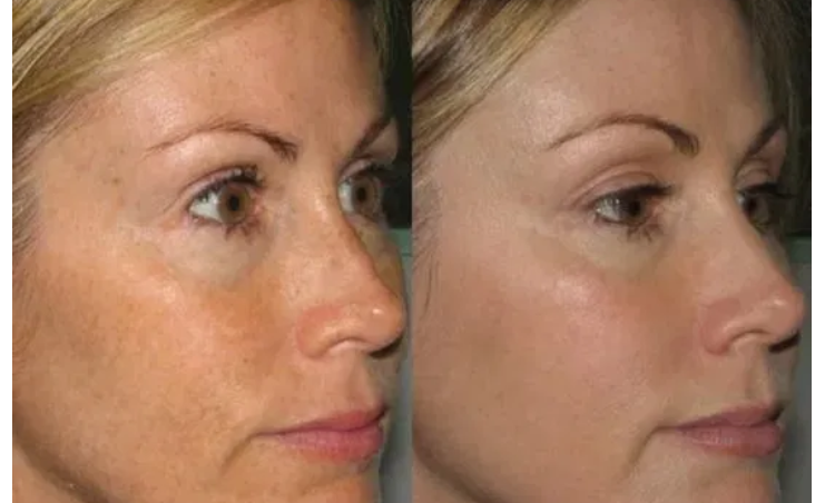 Facial skin photography - photo before and after