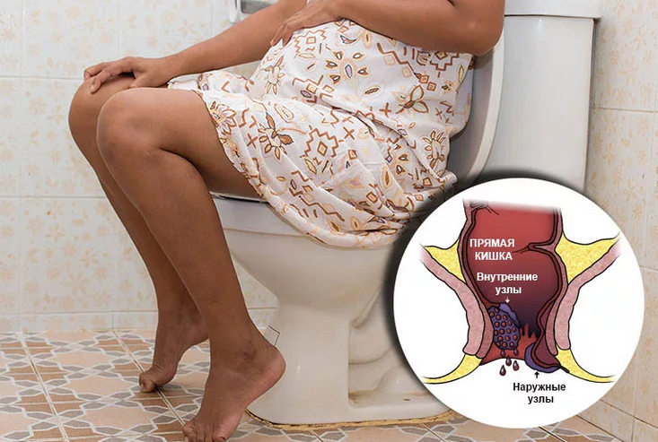 The causes of hemorrhoids during pregnancy