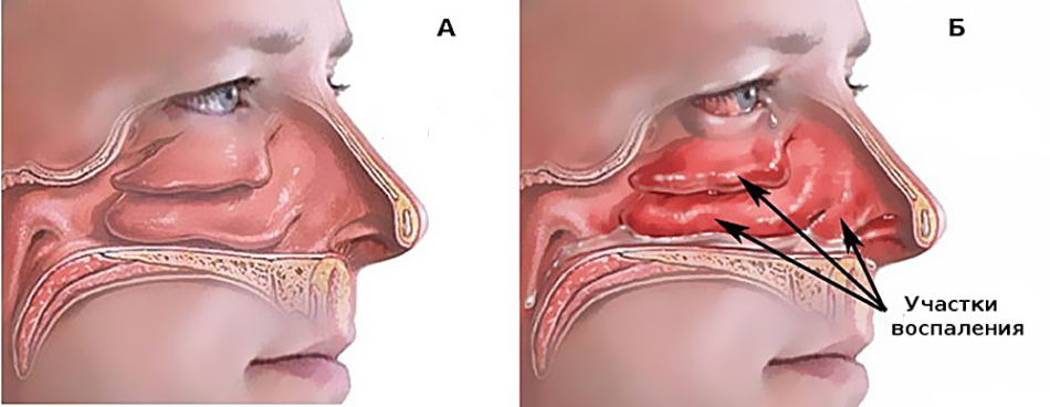 Inflammation dans le nez coulant chronique