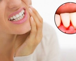 Gum inflammation: signs and causes, medication and folk remedies, prevention