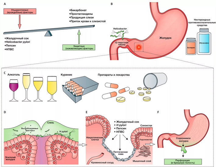 Causes and risk factors for the development of stomach ulcers