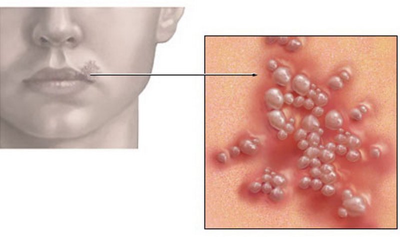 A nő testében a herpeszvírus az ajkán kiütés formájában relapszusokat adhat, immunitásának csökkenésével, beleértve a terhesség alatt is.