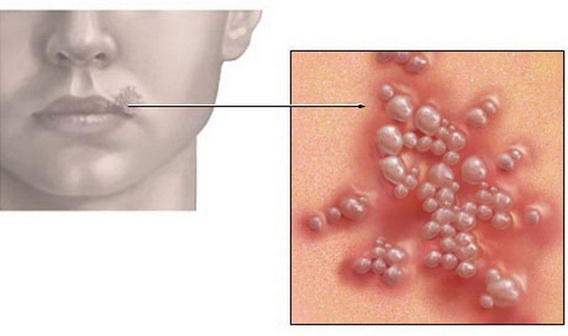 Einmal im Körper einer Frau kann das Herpesvirus Rückfälle in Form eines Ausschlags auf den Lippen mit einer Abnahme ihrer Immunität, einschließlich der Schwangerschaft, verleihen.